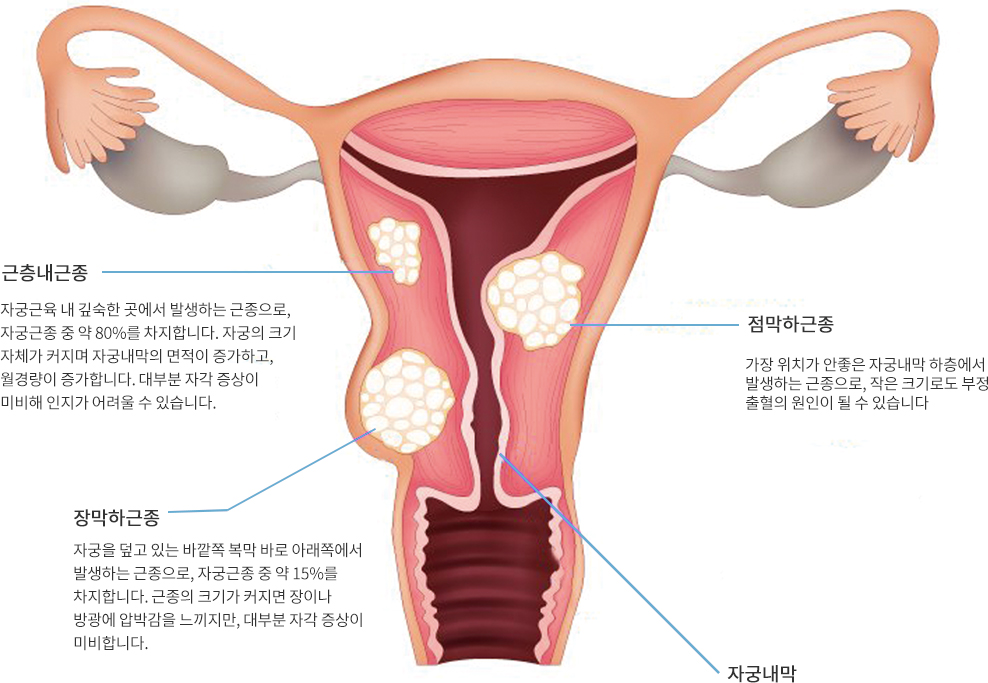 자궁근종의 종류