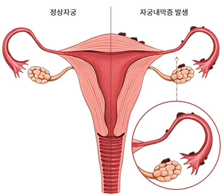 자궁내막증