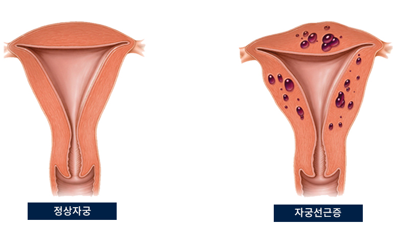 자궁선근증