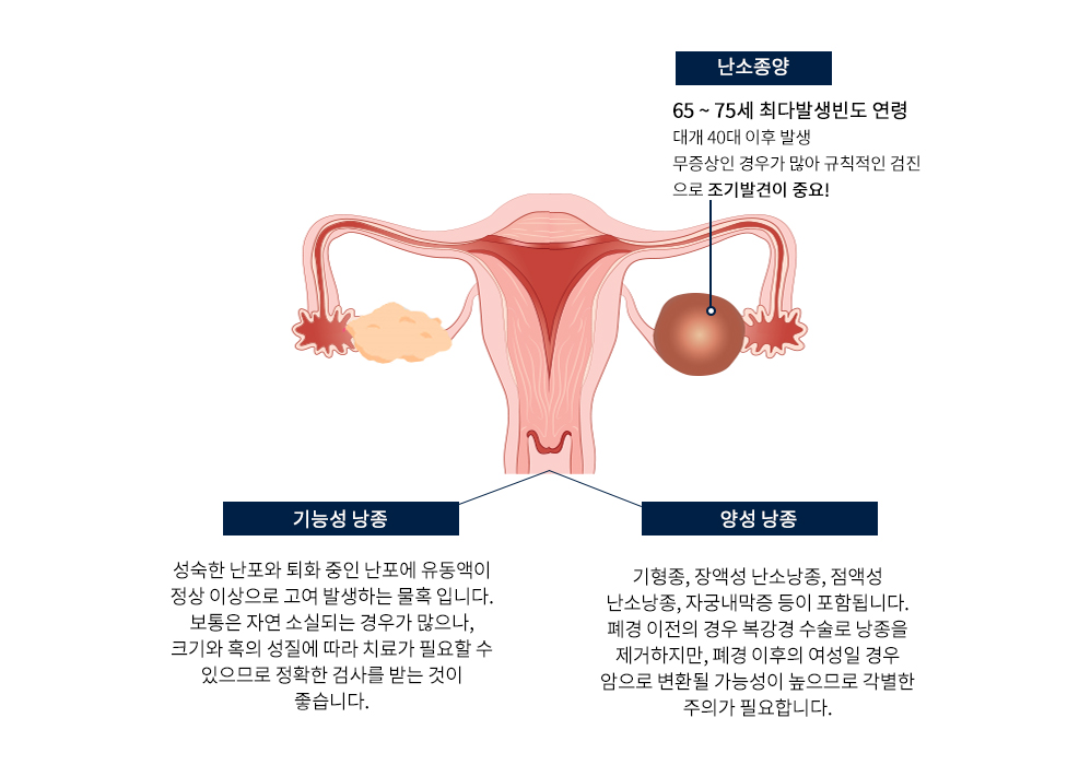 난소물혹 종류